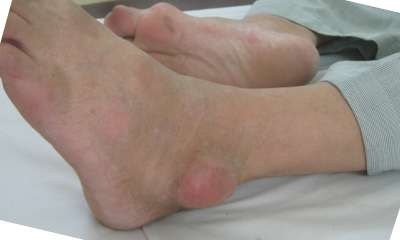 Фото подагры голеностопного сустава Фото подагры голеностопного сустава