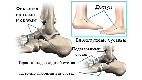 Исправление плоскостопия оперативным путем Исправление плоскостопия оперативным путем
