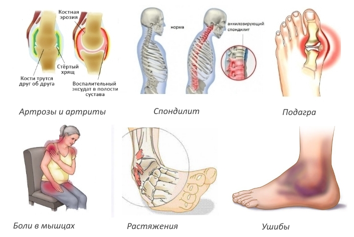 Показания для Кетопрофена Показания для Кетопрофена