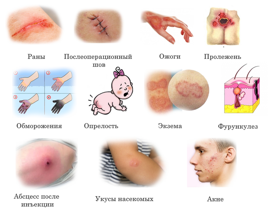 Показания для Левомеколя Показания для Левомеколя