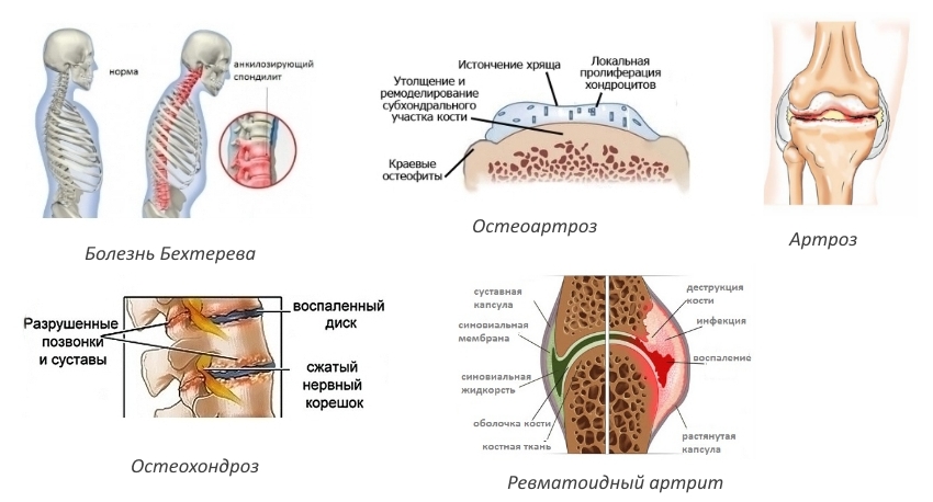 Показания для Мовалиса Показания для Мовалиса