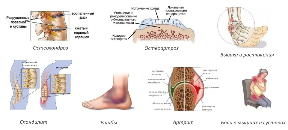 Показания для Артротека Показания для Артротека