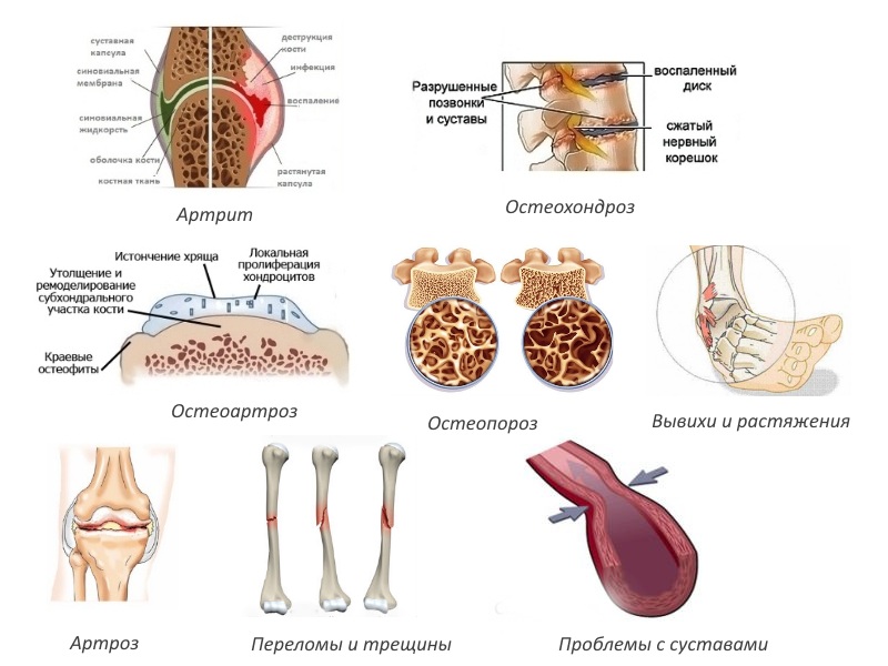 Показания для Артроцельса Показания для Артроцельса