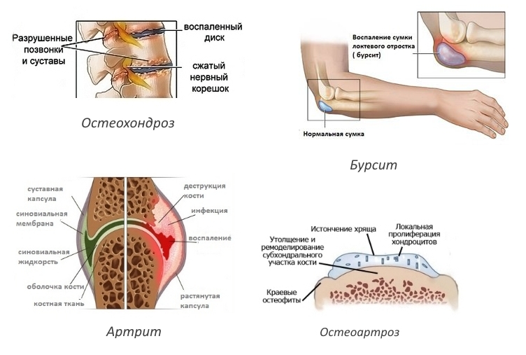 Показания для Диацереина Показания для Диацереина