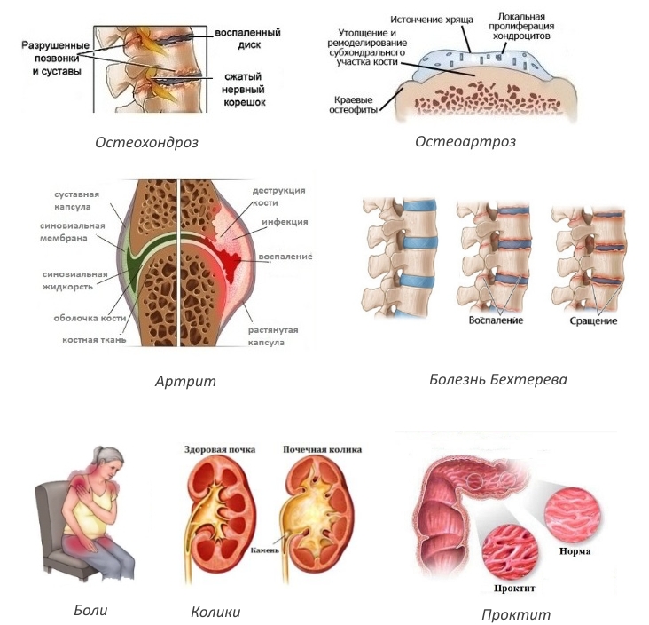 Показания для Диклоната П Показания для Диклоната П