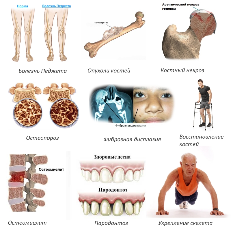 Показания для введения Кальцитрина Показания для введения Кальцитрина