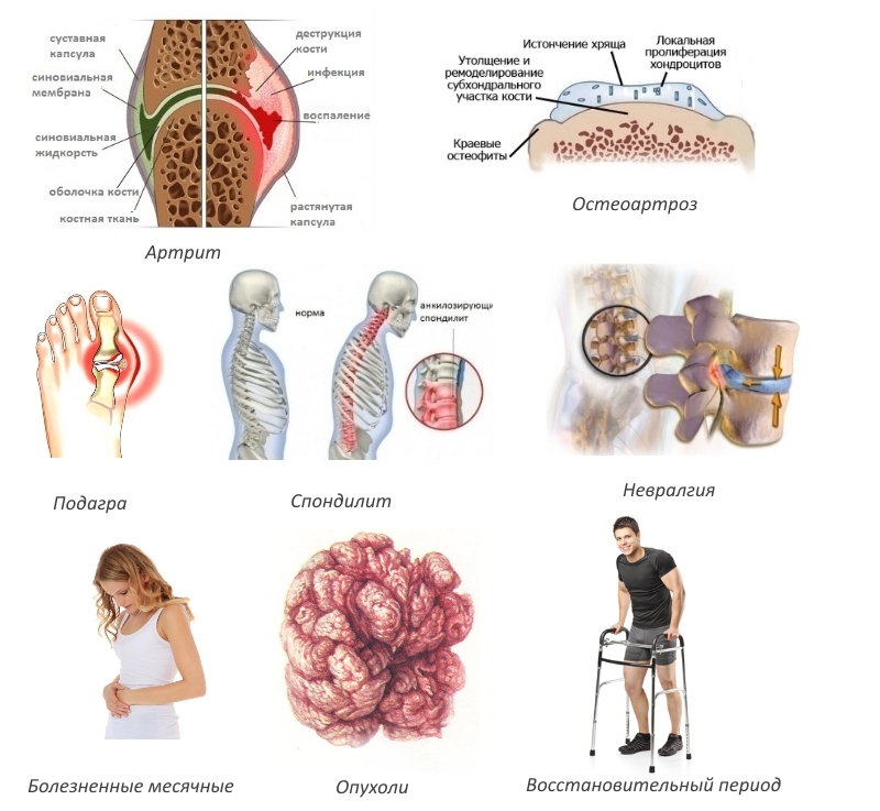 Показания для Кетонала Показания для Кетонала