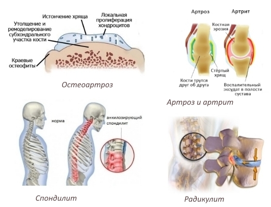 Показания для Мелоксикама Показания для Мелоксикама