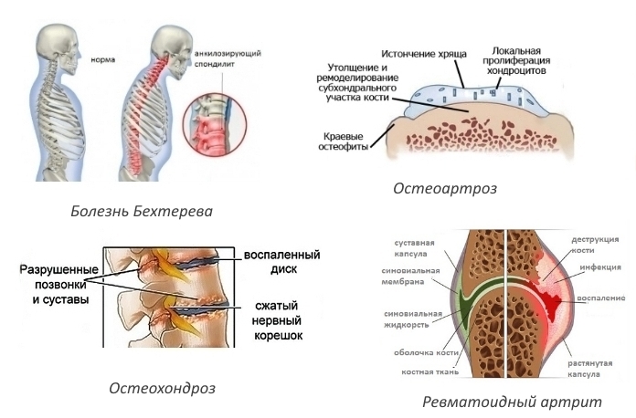 Показания для Амелотекса Показания для Амелотекса