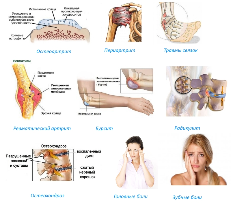 Показания для Рофекоксиба Показания для Рофекоксиба