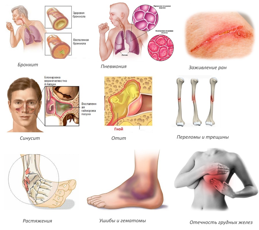 Показания для Серраты Показания для Серраты