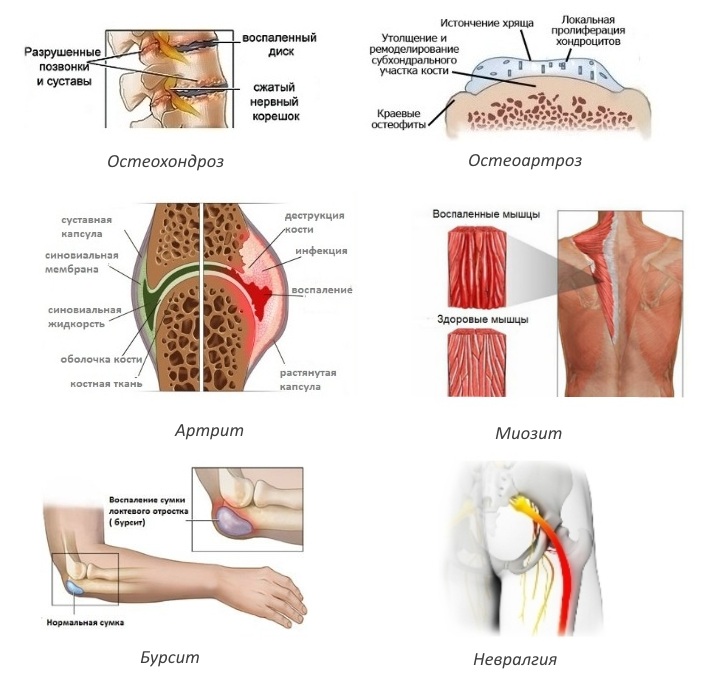 Показания для Вольтарен спрея Показания для Вольтарен спрея