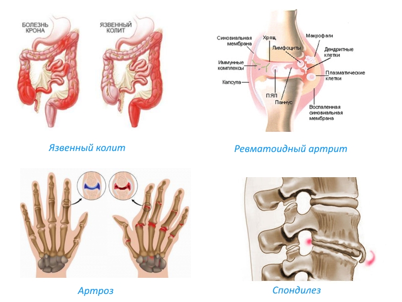 Показания для приема Артрофоона Показания для приема Артрофоона