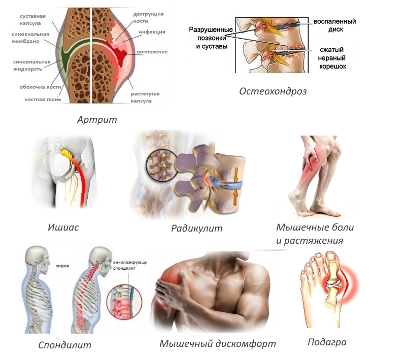 Показания для геля Кетопрофен Показания для геля Кетопрофен