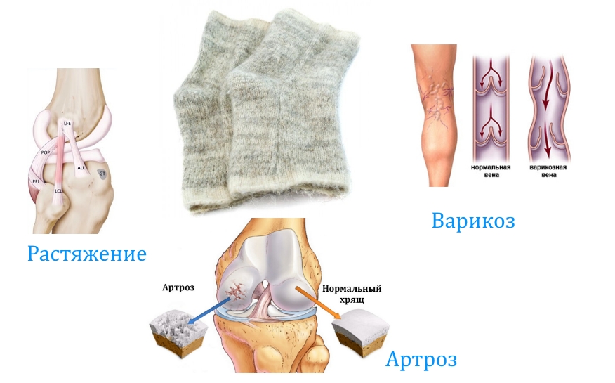 Показания для ношения наколенников Показания для ношения наколенников