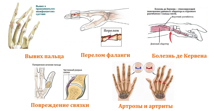 Показания для ношения ортеза на палец Показания для ношения ортеза на палец