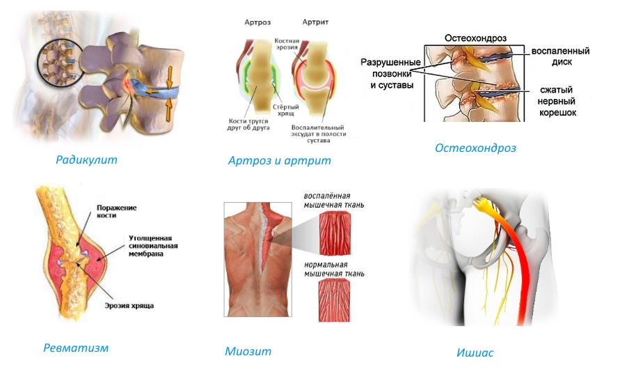 Показания для пластыря Кетонал Показания для пластыря Кетонал