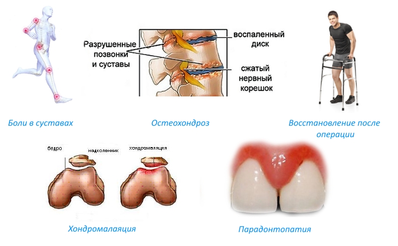 Показания для приема Артрон Флекс Показания для приема Артрон Флекс
