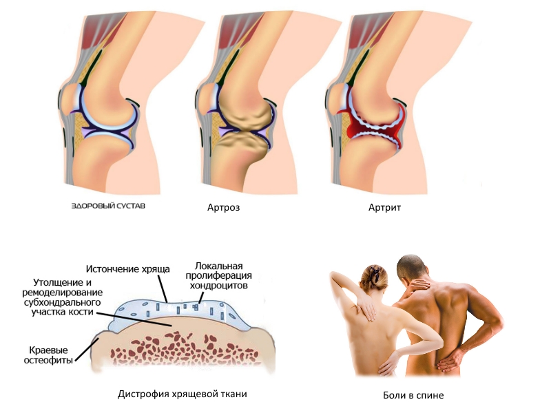 Показания для приема Артронормина Показания для приема Артронормина