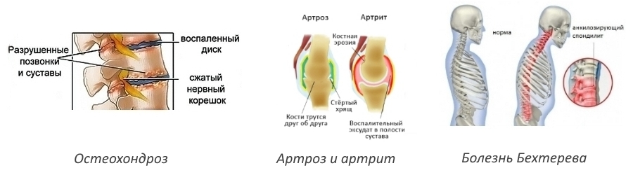 Показания для приема Мовасина Показания для приема Мовасина