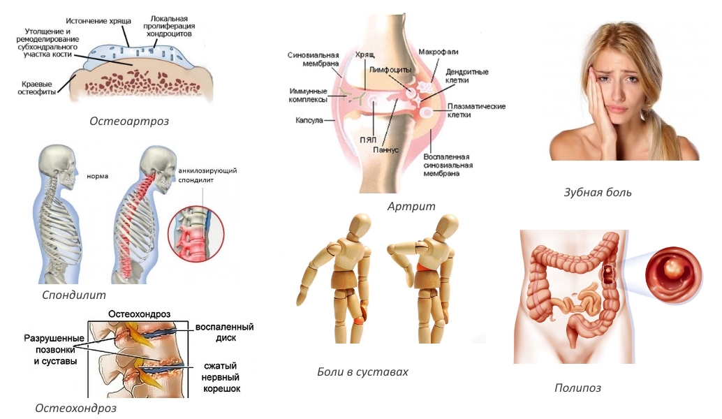 Показания для приема Целебрекса Показания для приема Целебрекса