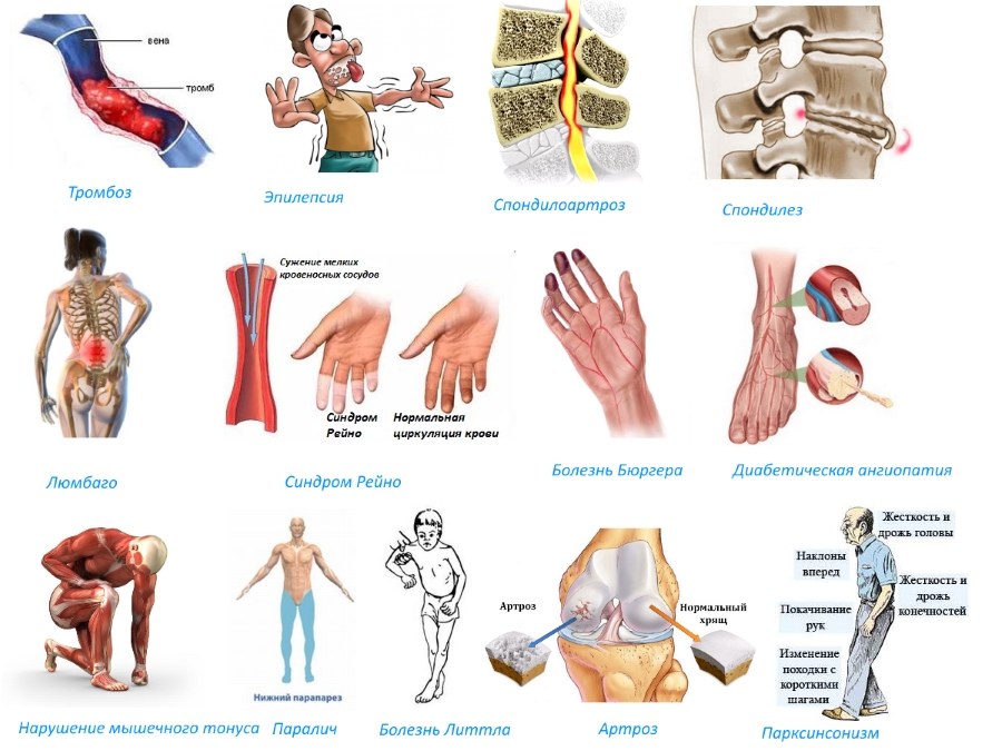Показания для приема Толперизона Показания для приема Толперизона