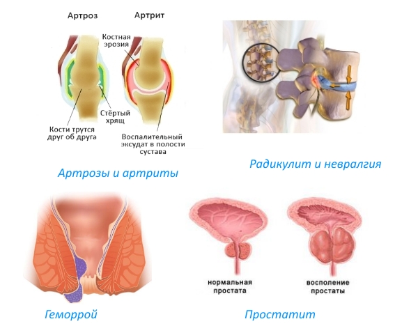 Показания для применения свечей Кетонала Показания для применения свечей Кетонала