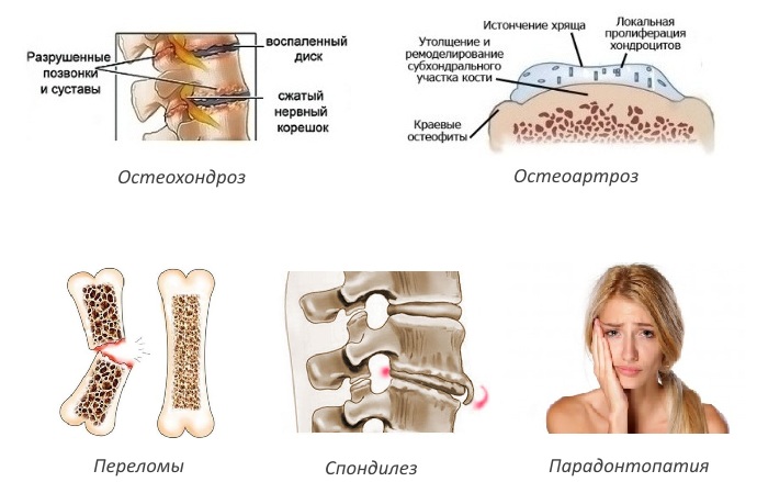 Показания для уколов Хондроитина Показания для уколов Хондроитина