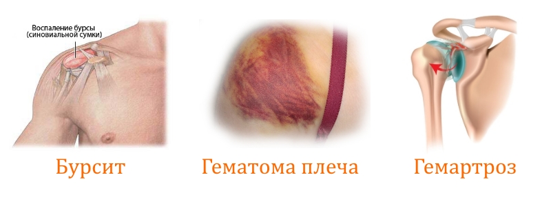 Показания для пункции плечевого сустава Показания для пункции плечевого сустава