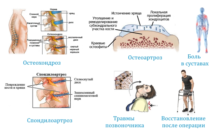 Показания к Артифлексу Показания к Артифлексу