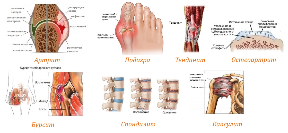 Показания к Артроколу Показания к Артроколу