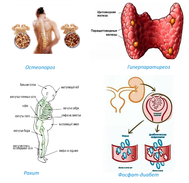 Показания к Рокальтролу Показания к Рокальтролу