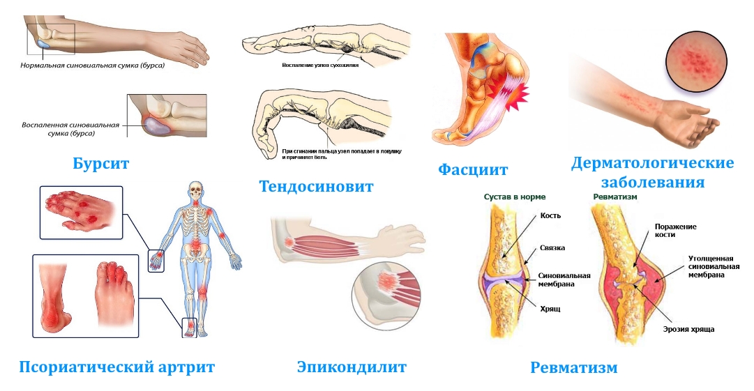 Показания для Флостерона Показания для Флостерона