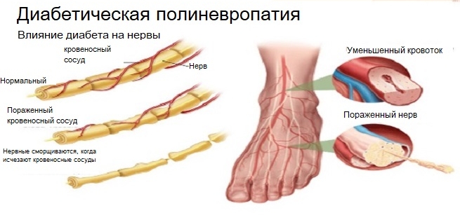 Полиневропатия Полиневропатия