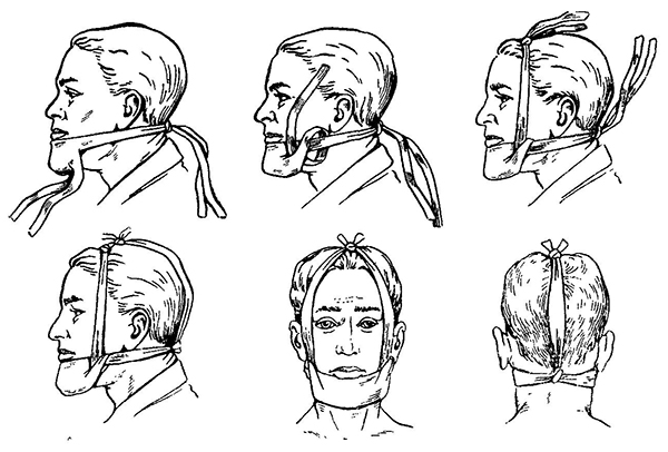 Пращевидная повязка на челюсть Пращевидная повязка на челюсть