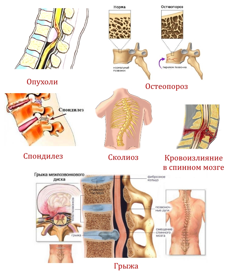 Причины для диагностики КТ позвоночника Причины для диагностики КТ позвоночника