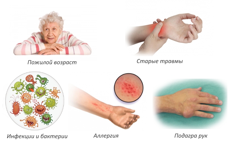 Причины артрита пальцев рук Причины артрита пальцев рук