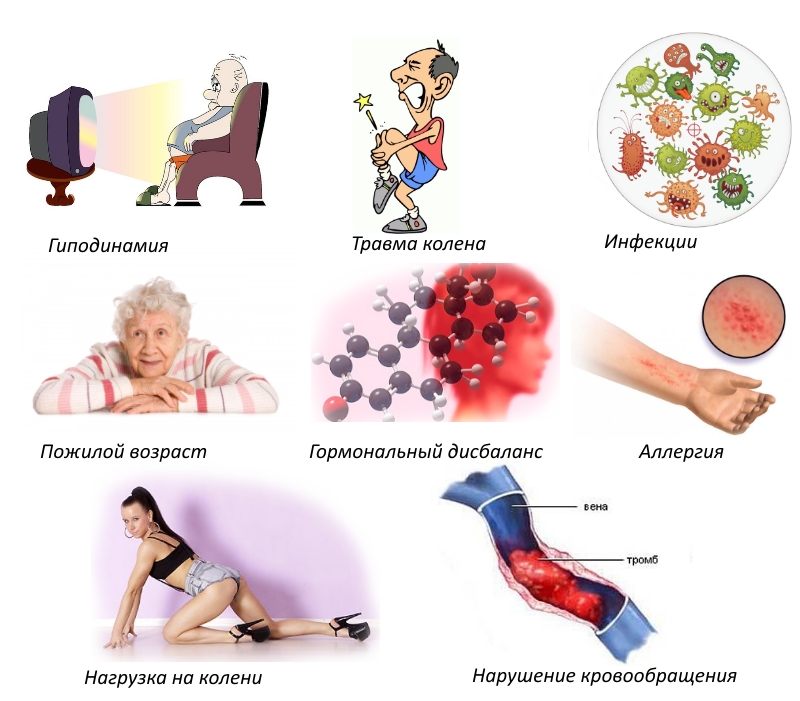 Причины артрита колена Причины артрита колена