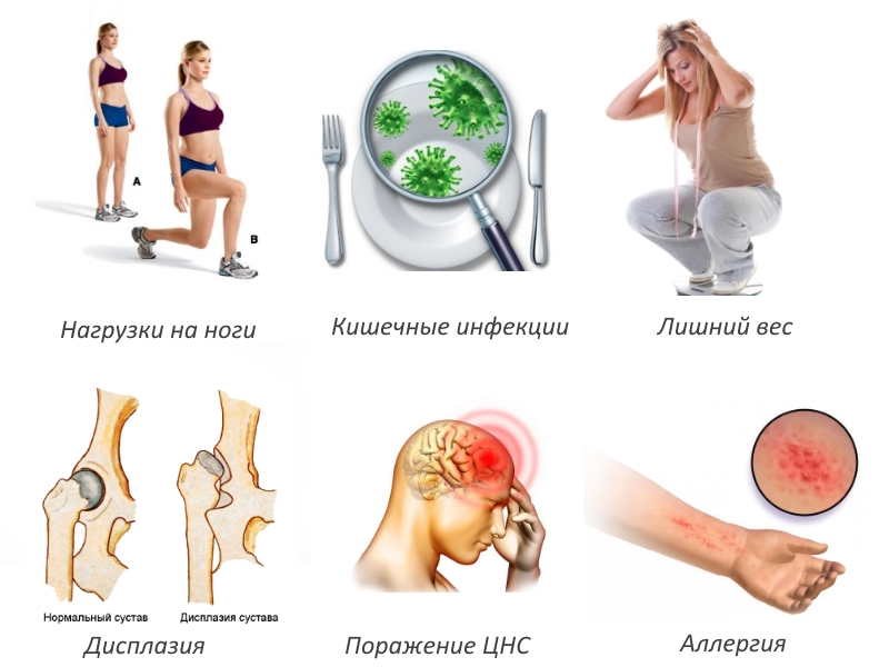 Частые причины артрита Частые причины артрита