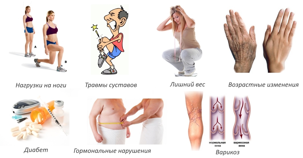 Причины гонартроза Причины гонартроза