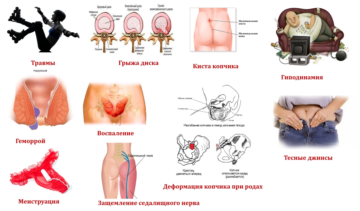 Причины болей в копчике Причины болей в копчике