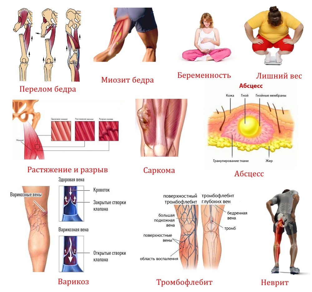 Причины боли в бедре Причины боли в бедре