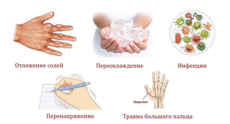 Причины боли в большом пальце руки Причины боли в большом пальце руки