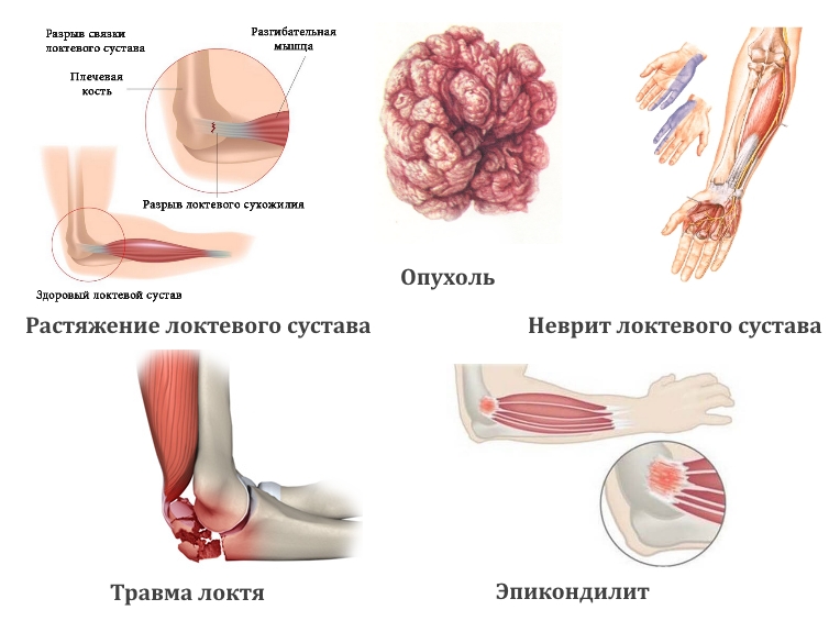 Причины боли в локте Причины боли в локте