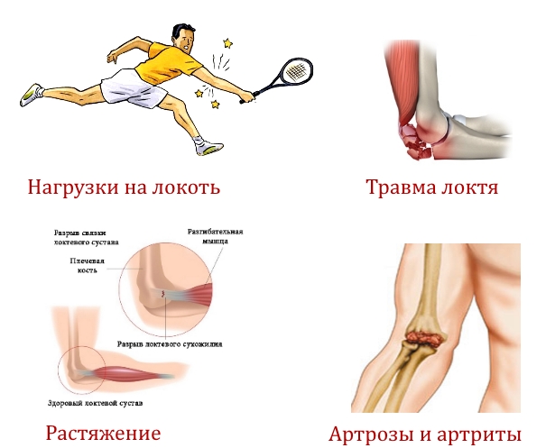 Частые причины боли в локте Частые причины боли в локте