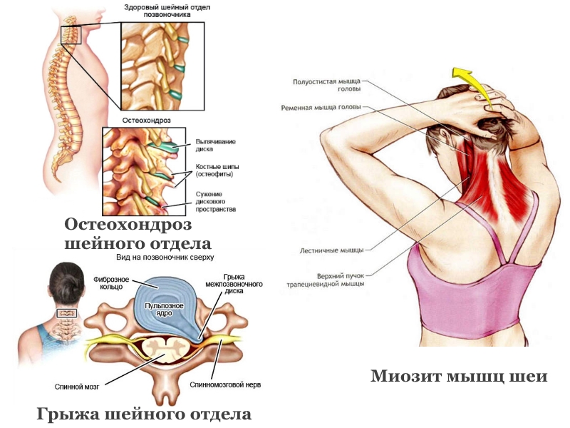 Причины боли в шее Причины боли в шее