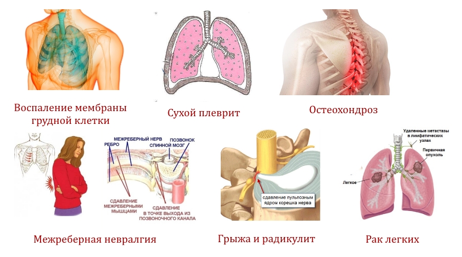 Причины боли в спине в области грудной клетки Причины боли в спине в области грудной клетки