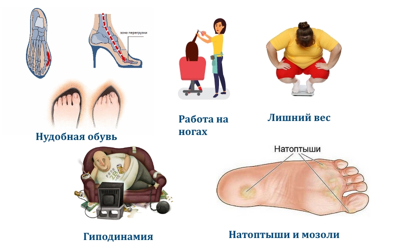 Частые причины боли в ступнях Частые причины боли в ступнях