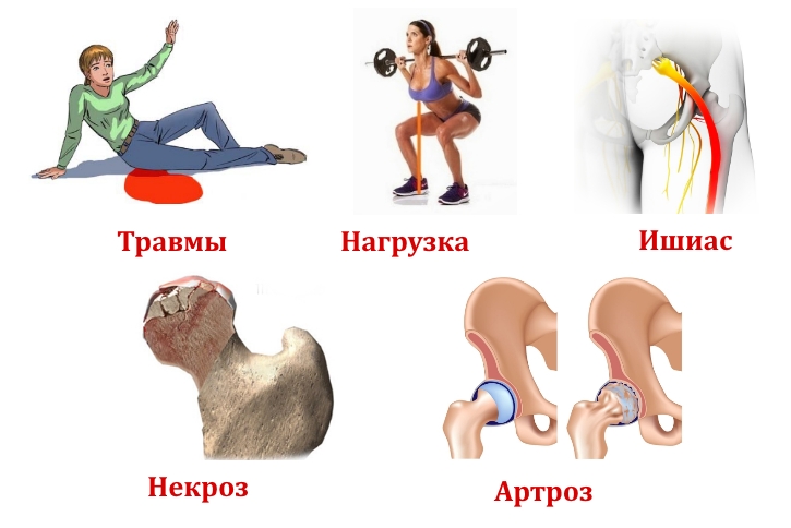 Причины боли в тазу и ноге Причины боли в тазу и ноге