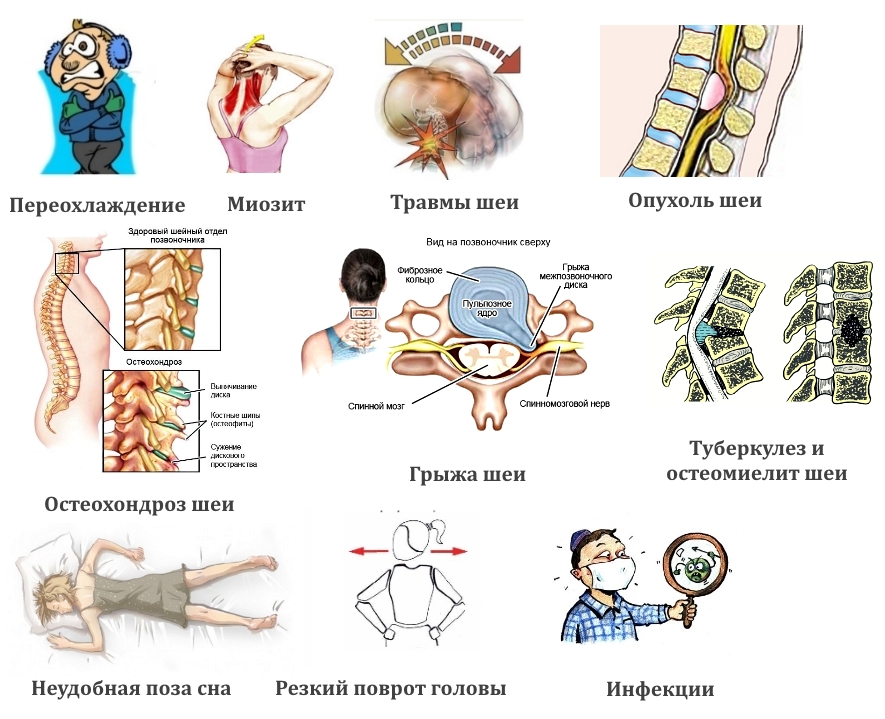 Причины боли в шее Причины боли в шее